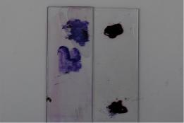 Undesired cytological specimen: Thick material located in one spot, not distributed and smeared all over the slide.