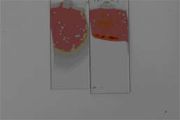 Inadequate blood film